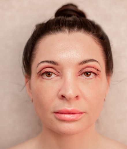 Interface Aesthetics Training Academy - Complications in Non-Surgical Aesthetics: Blepharoptosis