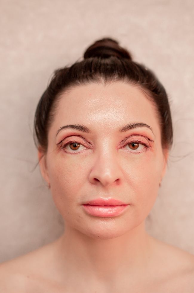 Interface Aesthetics Training Academy - Complications in Non-Surgical Aesthetics: Blepharoptosis