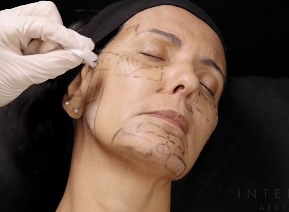 Interface Aesthetics Training Academy - Mastery in Injectables at Interface Aesthetics.